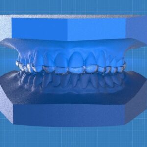 Digital Ortho Anterior Repositioner Splint